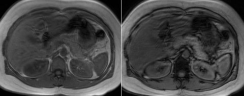 Conventional In/Out of Phase: Imaging demonstrates diffuse drop of signal, consistent with fatty infiltration. However we are not able to quantify fat with this method alone.