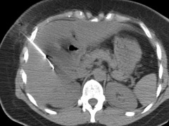 CT Guided Right Lobe Biopsy: Pathology: Mild (5-33%) Steatosis.