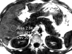 New MEGRE sequence produces a Fat Percentage Map: In the location of the liver biopsy, this demonstrates 12.1 % Fat content.