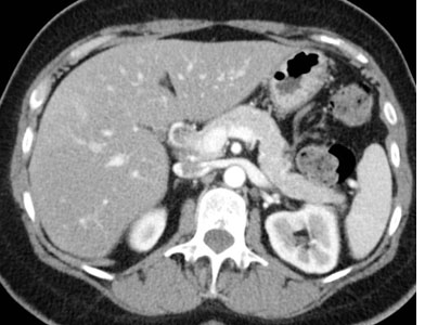 50 year old ovarian cancer. Liver MRI performed with EOB-DTPA demonstrates multiple lesions in the liver that were not seen on CT