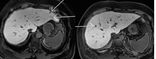 50 year old ovarian cancer. Liver MRI performed with EOB-DTPA demonstrates multiple lesions in the liver that were not seen on CT