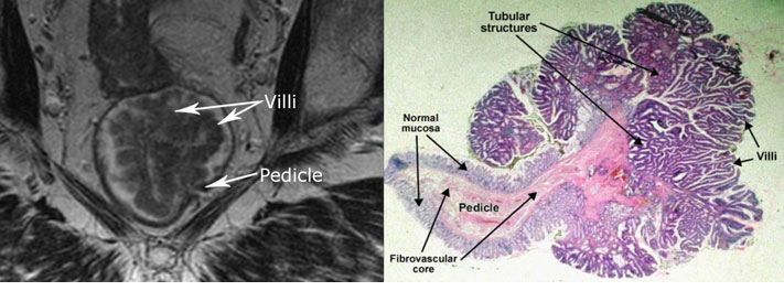 Histologic correlation demonstrates excellent characterization of the lesion.