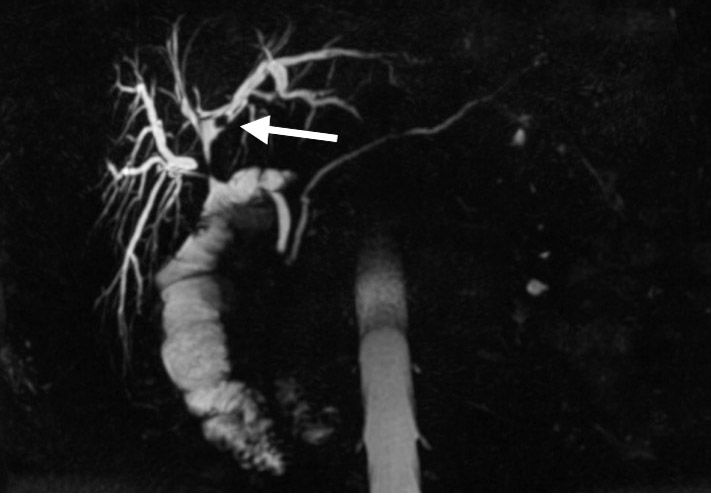 62 year old who presents with abdominal pain. MRCP images demonstrate an intrahepatic biliary stone.